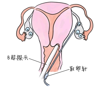 小儿退烧推拿手法 5种贵阳捐卵宝宝退烧按摩方法